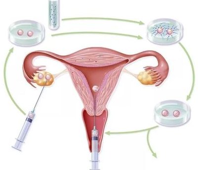 马来西亚试管婴儿是怎么收费的？费用攻略!